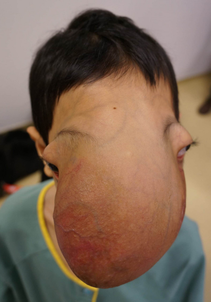 Craniofacial Malignant Tumor